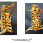 artere-vertebrale